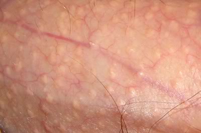 fordyce spots closeup photo