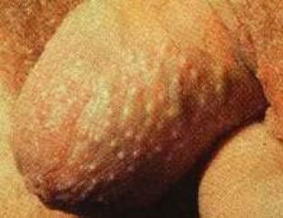 fordyce spots on the penis head