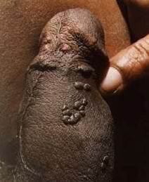 bad case of warts on the underside of mans shaft